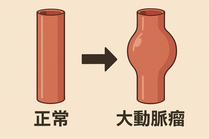 大動脈瘤（胸部・腹部）