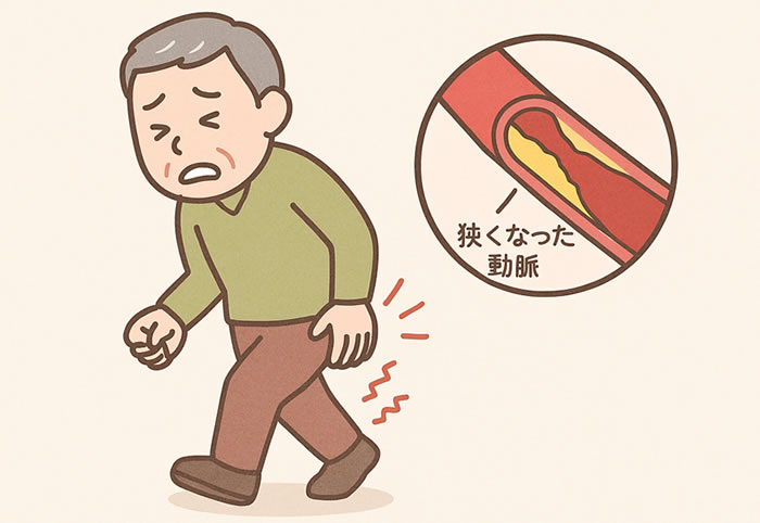 閉塞性動脈硬化症