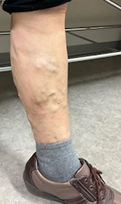 下肢静脈瘤